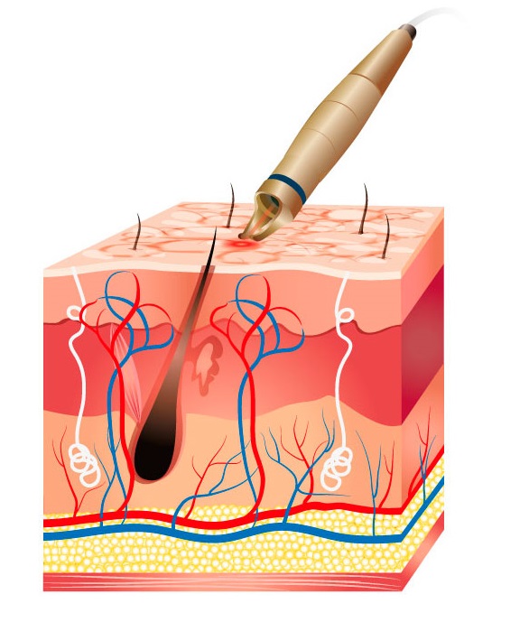 laser-udaleniya-sosudov.jpg